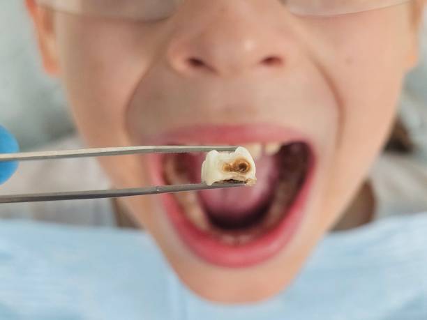 Best Emergency Dental Care for Broken or Chipped Teeth in Wagener, SC