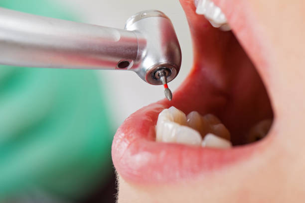Best Emergency Wisdom Teeth Removal in Wagener, SC